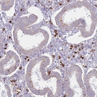Immunohistochemical staining of human endometrium shows strong cytoplasmic positivity in stromal cells.