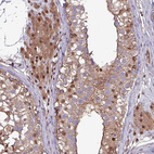 Immunohistochemical staining of human testis shows moderate cytoplasmic-nucleus positivity in Leydig cells and cells in seminiferous duct.