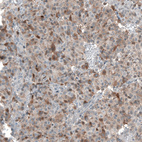 Immunohistochemical staining of human glioma shows moderate cytoplasmic positivity in tumor cells.