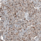 Immunohistochemical staining of human glioma shows moderate cytoplasmic positivity in tumor cells.