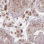 Immunohistochemical staining of human testis shows strong granular cytoplasmic positivity in Leydig cells.