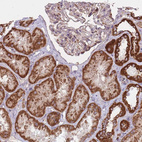Immunohistochemical staining of human kidney shows strong granular cytoplasmic positivity in cells in tubules.