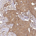 Immunohistochemical staining of human breast cancer shows moderate cytoplasmic positivity in tumor cells.