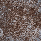 Immunohistochemical staining of human chronic lymphocytic leukemia shows strong membranous positivity in tumor cells.
