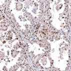 Immunohistochemical staining of human ovarian cancer (clear cell carcinoma) shows moderate nuclear positivity in a subset of tumor cells.