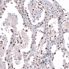 Immunohistochemical staining of human ovarian cancer (clear cell carcinoma) shows moderate nuclear positivity in tumor cells.