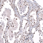 Immunohistochemical staining of human ovarian cancer (clear cell carcinoma) shows moderate nuclear positivity in tumor cells.