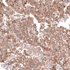 Immunohistochemical staining of human ovarian cancer (dysgeminoma) shows moderate membranous positivity in tumor cells.
