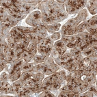 Immunohistochemical staining of human liver cancer (hepatocellular carcinoma) shows moderate membranous positivity in tumor cells.
