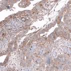 Immunohistochemical staining of human ovarian cancer (papillary carcinoma) shows moderate membranous positivity in tumor cells.