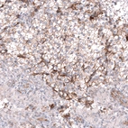 Immunohistochemical staining of human testis cancer (seminoma) shows moderate membranous positivity in tumor cells.