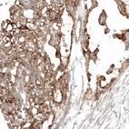 Immunohistochemical staining of human ovarian cancer (yolk sack tumor) shows moderate membranous positivity in tumor cells.