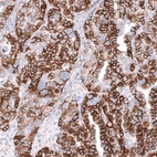 Immunohistochemical staining of human ovarian cancer (papillary serous cystadenocarcinoma) shows strong membranous positivity in tumor cells.