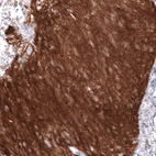 Immunohistochemical staining of human malignant glioma shows strong positivity in tumor cells.