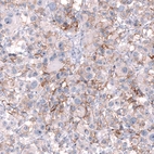 Immunohistochemical staining of human malignant melanoma shows moderate membranous positivity in tumor cells.