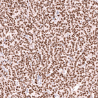 Immunohistochemical staining of human ovarian cancer (granulosa cell tumour) shows strong nuclear positivity in tumor cells.