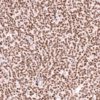 Immunohistochemical staining of human ovarian cancer (granulosa cell tumour) shows strong nuclear positivity in tumor cells.