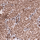 Immunohistochemical staining of human ovarian cancer (sex cord tumor) shows strong nuclear positivity in tumor cells.