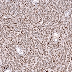 Immunohistochemical staining of human ovarian cancer (granulosa cell tumor) shows moderate to strong nuclear positivity in tumor cells.