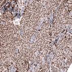 Immunohistochemical staining of human ovarian cancer (sex cord tumor) shows moderate nuclear positivity in tumor cells.