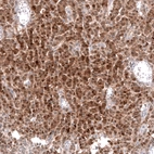 Immunohistochemical staining of human ovarian cancer (granular cell carcinoma) shows moderate cytoplasmic positivity in tumor cells.