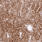 Immunohistochemical staining of human ovarian cancer (granular cell carcinoma) shows moderate cytoplasmic positivity in tumor cells.