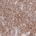 Immunohistochemical staining of human ovarian cancer (granular cell carcinoma) shows moderate cytoplasmic positivity in tumor cells.