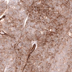 Immunohistochemical staining of human ovarian cancer (high grade serous carcinoma) shows moderate to strong membranous positivity in tumor cells.