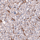 Immunohistochemical staining of human malignant melanoma shows moderate membranous positivity in tumor cells.