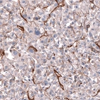 Immunohistochemical staining of human malignant melanoma shows moderate membranous positivity in tumor cells.
