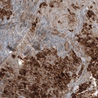 Immunohistochemical staining of human endometrial cancer shows moderate to strong cytoplasmic positivity in tumor cells.