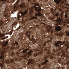 Immunohistochemical staining of human ovarian cancer (endometrioid carcinoma) shows strong cytoplasmic positivity in tumor cells.