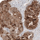 Immunohistochemical staining of human ovarian cancer (papillary carcinoma) shows moderate to strong cytoplasmic positivity in tumor cells.