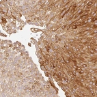 Immunohistochemical staining of human urothelial cancer shows moderate cytoplasmic and membranous positivity in tumor cells.