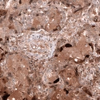 Immunohistochemical staining of human ovarian cancer (endometrioid carcinoma) shows moderate cytoplasmic positivity in tumor cells.
