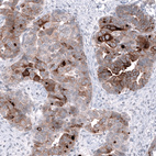 Immunohistochemical staining of human ovarian cancer (papillary carcinoma) shows moderate to strong cytoplasmic positivity in tumor cells.