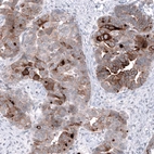 Immunohistochemical staining of human ovarian cancer (papillary carcinoma) shows moderate to strong cytoplasmic positivity in tumor cells.