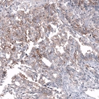 Immunohistochemical staining of human ovarian cancer (yolk sack tumor) shows moderate membranous positivity in tumor cells.