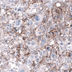 Immunohistochemical staining of human malignant melanoma shows moderate membranous positivity in tumor cells.
