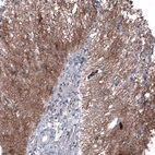 Immunohistochemical staining of human glioma shows moderate membranous positivity in tumor cells.