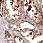 Immunohistochemical staining of human ovarian cancer (clear cell carcinoma) shows moderate to strong granular cyoplasmic positivity in tumor cells.