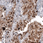 Immunohistochemical staining of human lung cancer (adenocarcinoma) shows moderate to strong positivity in tumor cells.