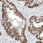 Immunohistochemical staining of human colorectal cancer shows strong nuclear positivity in tumor cells.