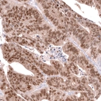 Immunohistochemical staining of human colorectal cancer (metastasis to ovary) shows moderate to strong nuclear positivity in tumor cells.