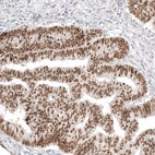 Immunohistochemical staining of human colorectal cancer shows strong nuclear positivity in tumor cells.