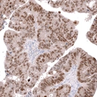 Immunohistochemical staining of human colorectal cancer (metastasis to ovary) shows moderate to strong nuclear positivity in tumor cells.
