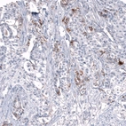 Immunohistochemical staining of human ovarian cancer (high grade serous carcinoma) shows moderate membranous positivity in a subset of tumor cells.