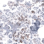 Immunohistochemical staining of human ovarian cancer (clear cell carcinoma) shows moderate membranous positivity in tumor cells.