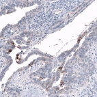 Immunohistochemical staining of human ovarian cancer (papillary carcinoma) shows moderate membranous positivity in a subset of tumor cells.