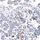 Immunohistochemical staining of human ovarian cancer (clear cell carcinoma) shows moderate membranous positivity in a subset of tumor cells.